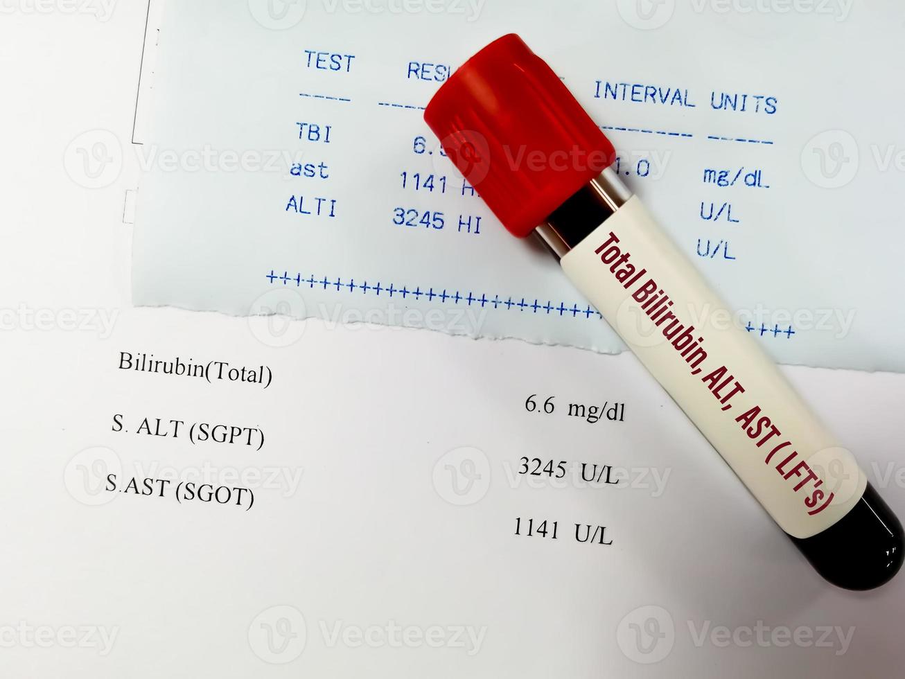 Blood sample for ALT, AST and Total Bilirubin test with abnormal report. LFTs or Liver Function Tests. photo