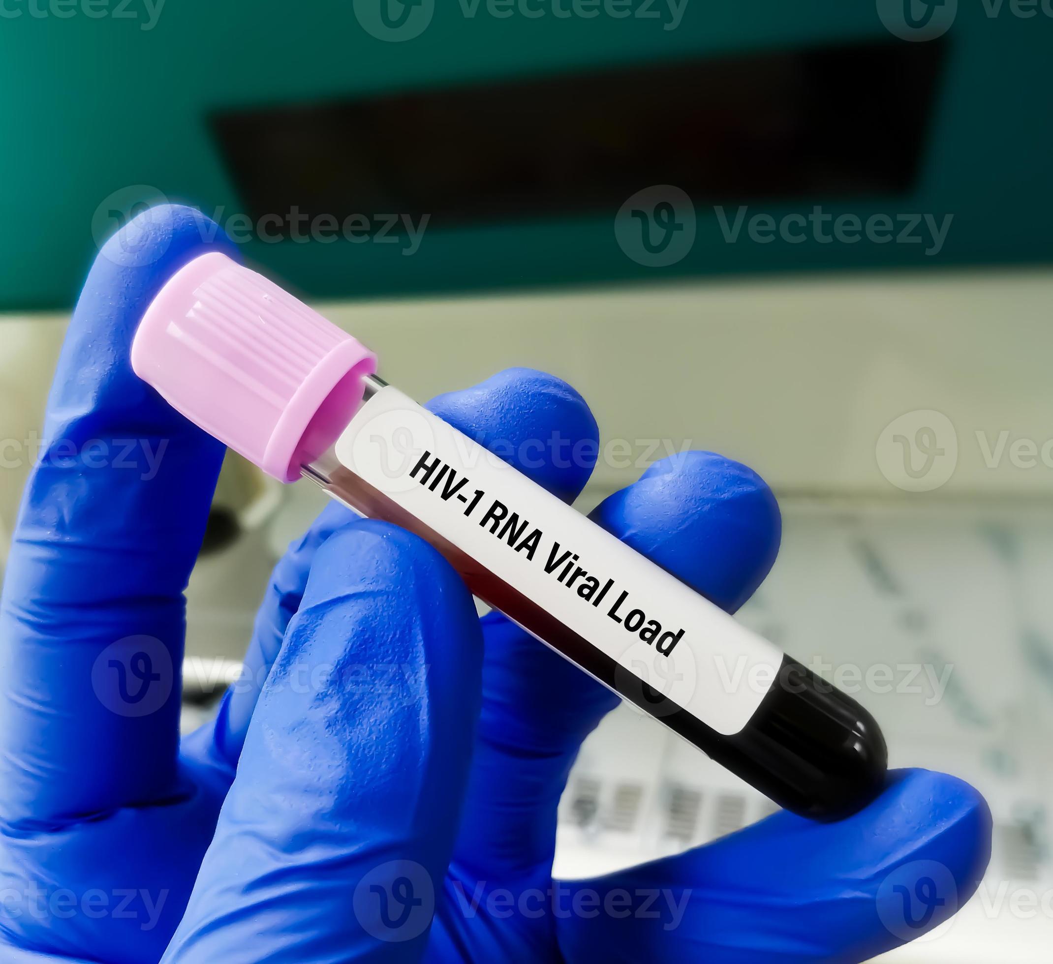 Blood sample for HIV 1 RNA viral load test. 8930954 Stock Photo at Vecteezy