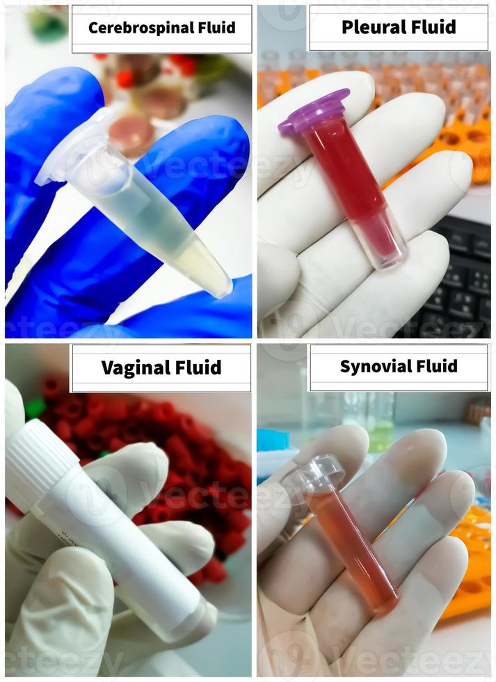 Photo collage of different types of human body fluid sample including cerebrospinal, pleural, synovial and vaginal for biochemical analysis to disease diagnosis.