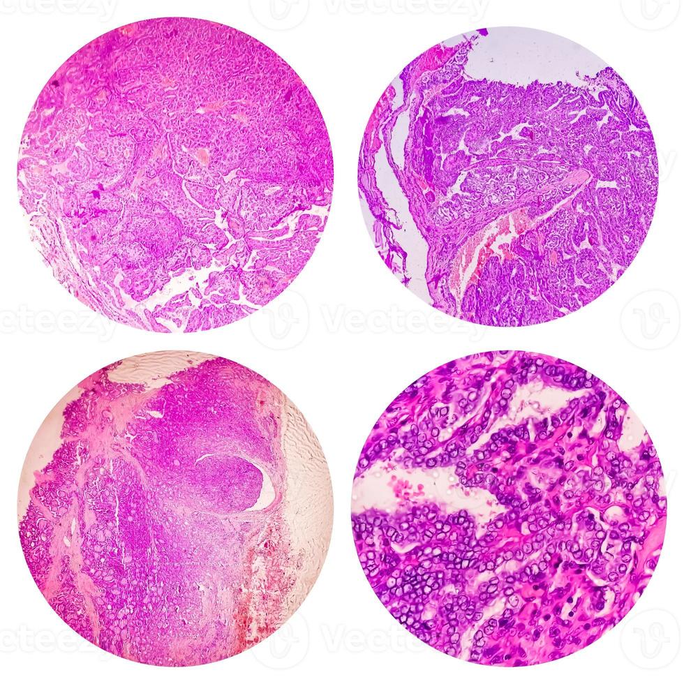 Photo collage of microscopic image showing Papillary thyroid carcinoma.