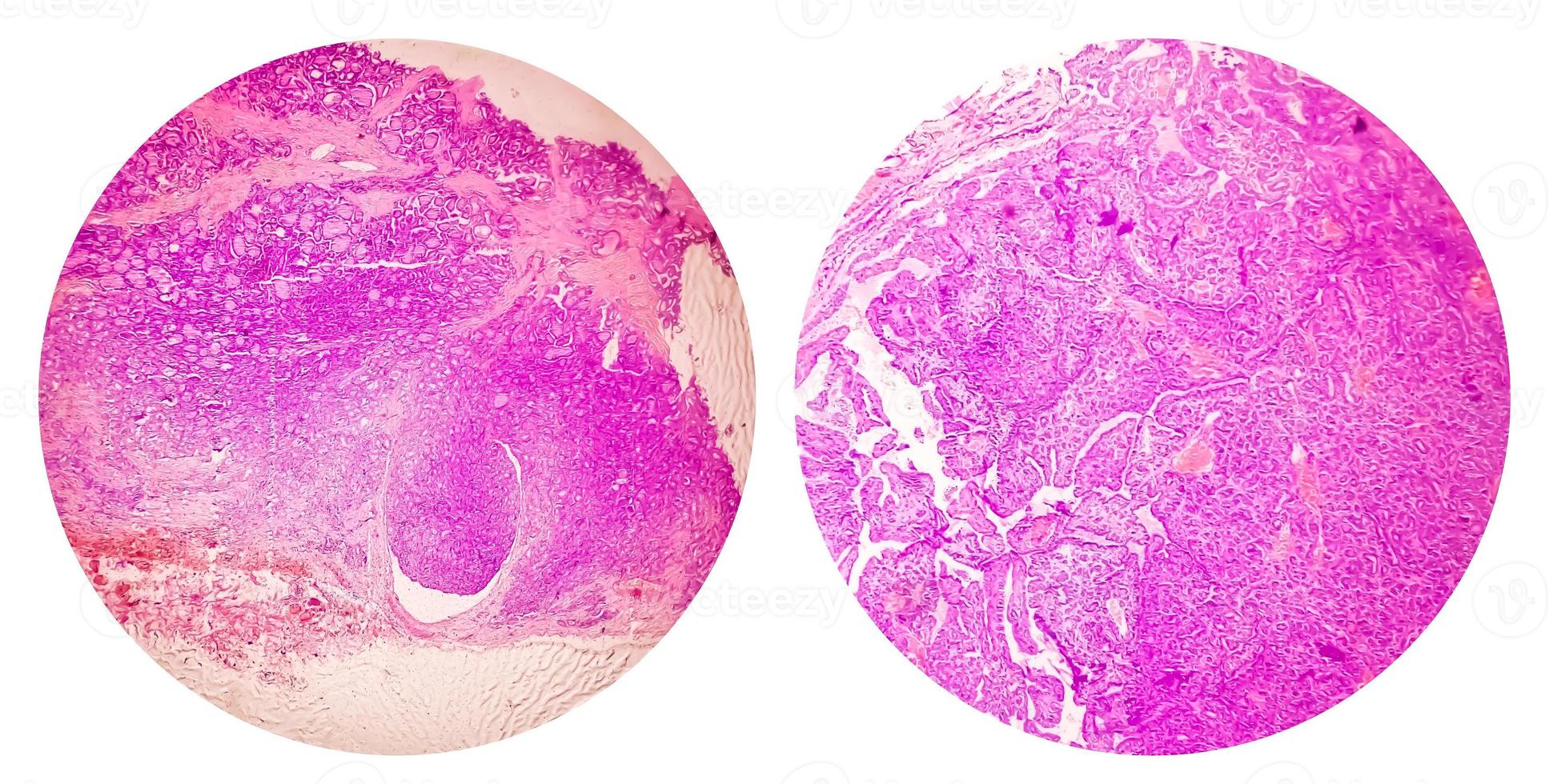 Photo collage of microscopic image showing Papillary thyroid carcinoma.