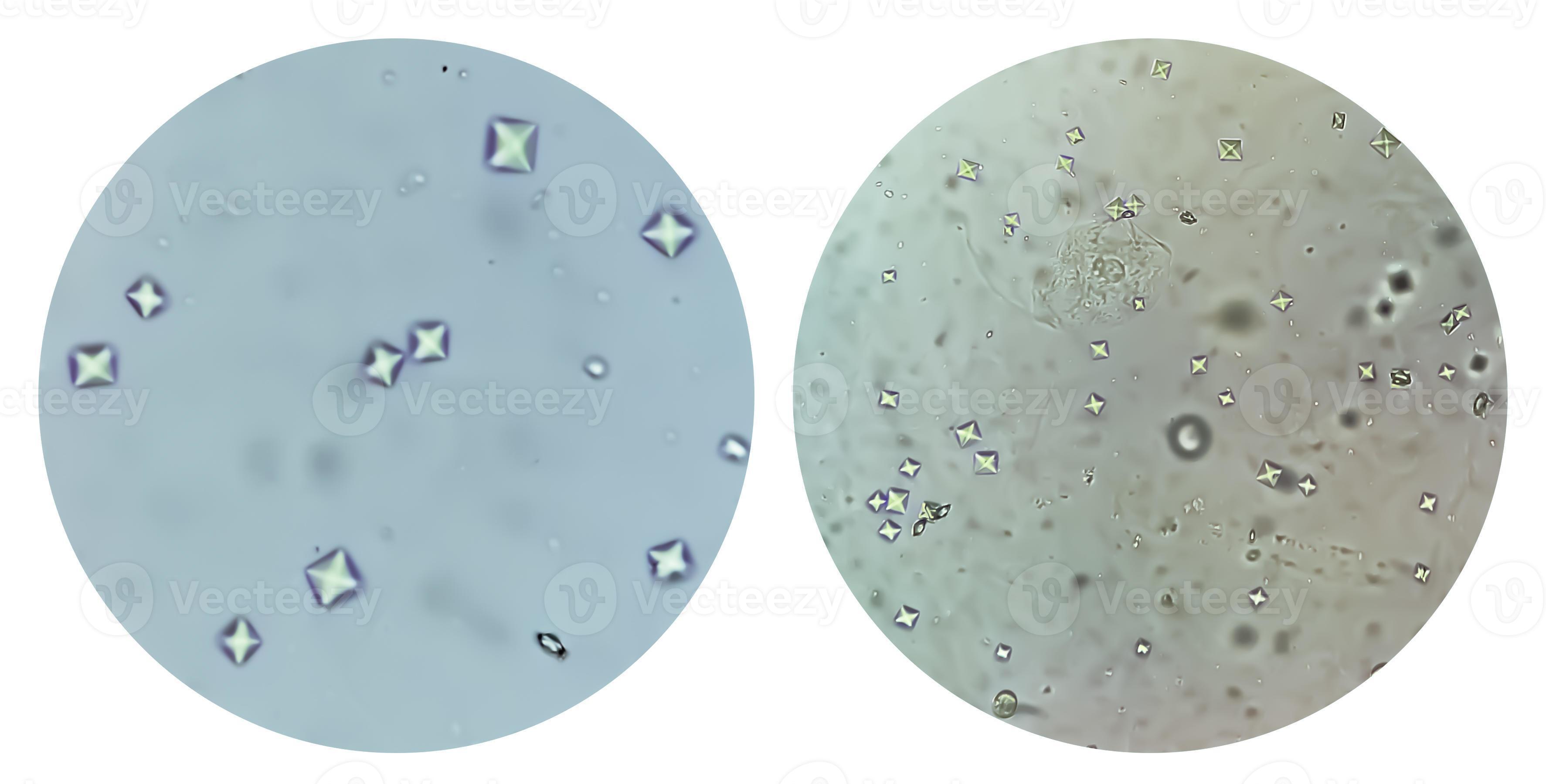 Calcium oxalate crystal from urine sediment. 8930973 Stock Photo at