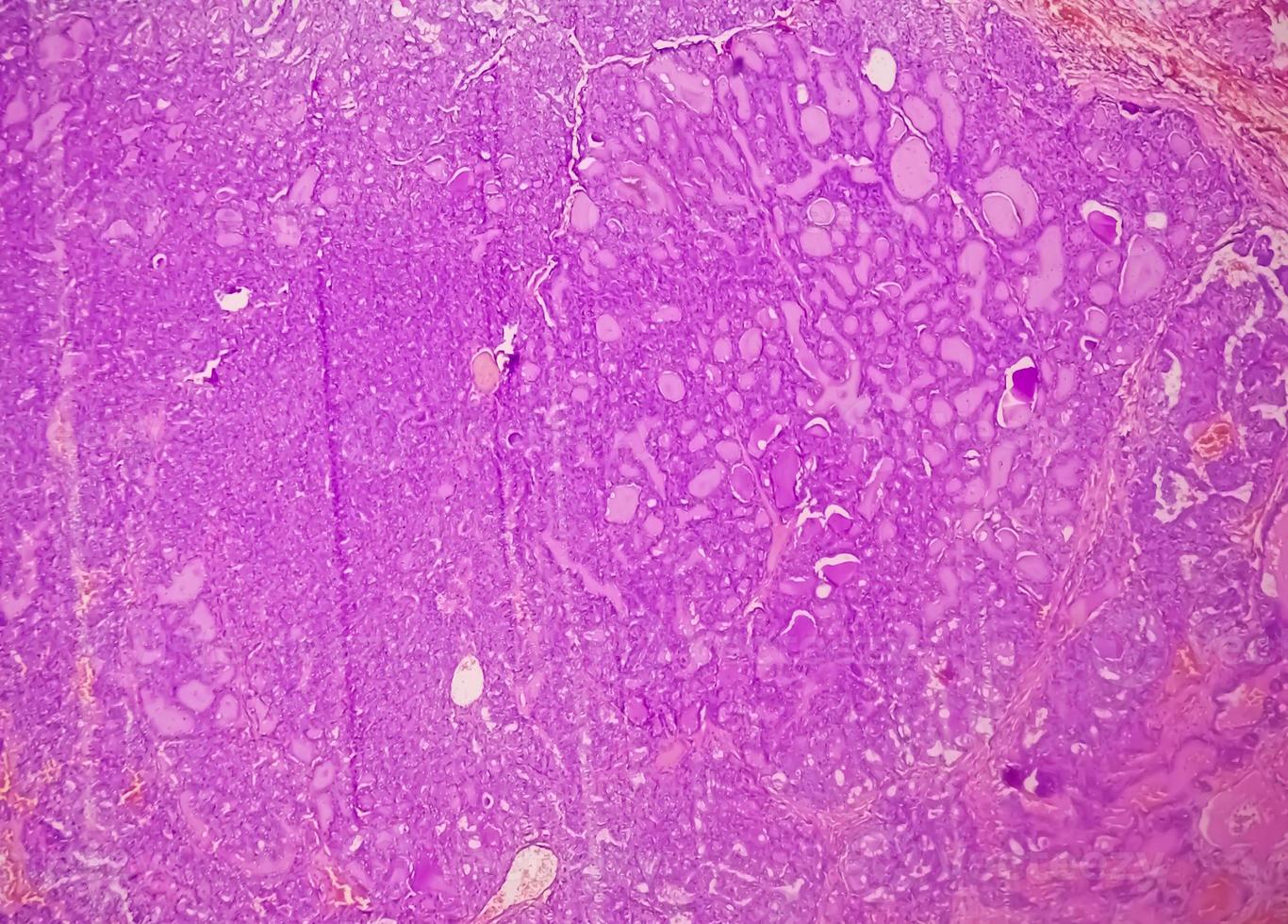 Thyroid cancer, Microscopic image of Metastatic papillary carcinoma of thyroid, central lymph node. photo