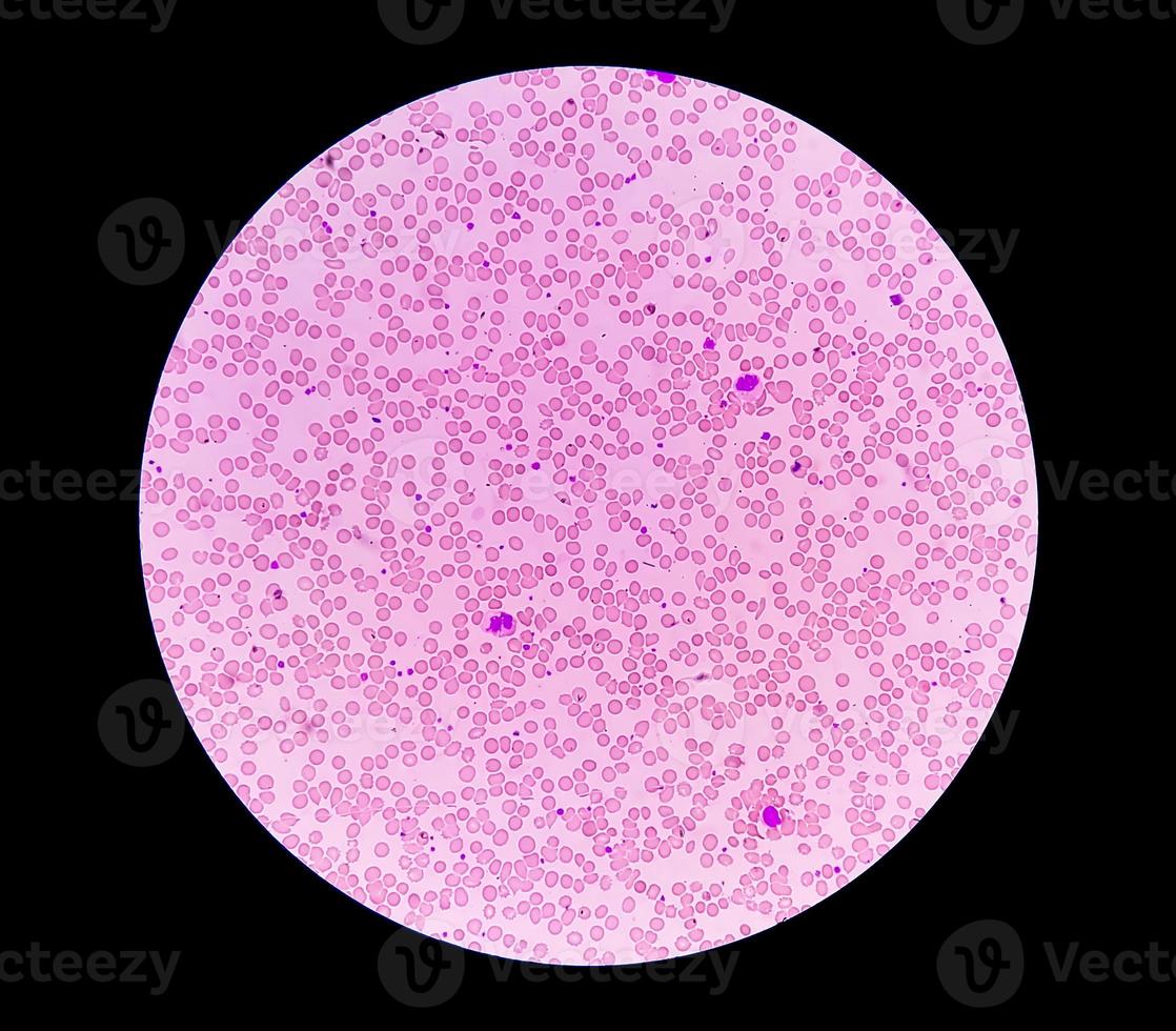 Photomicrograph or microscopic image showing Hemoglobin D trait with iron deficiency anemia. photo