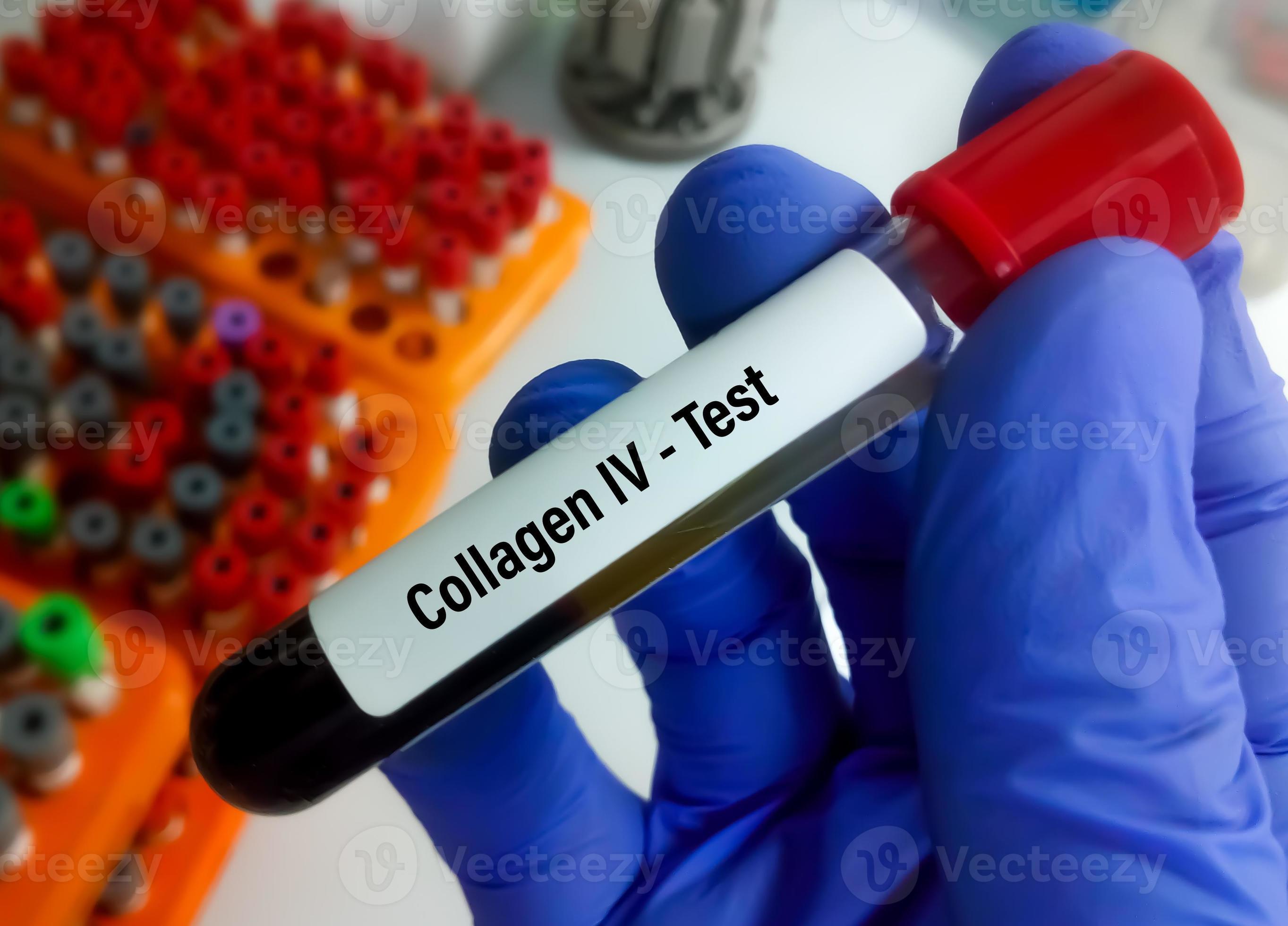 Blood sample for type IV collagen test. collagen antibody test, to