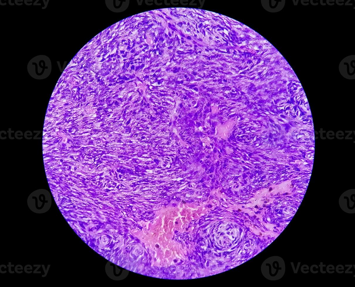 Photomicrograph of a schwannoma, a benign soft tissue tumor of peripheral nerve sheath. photo