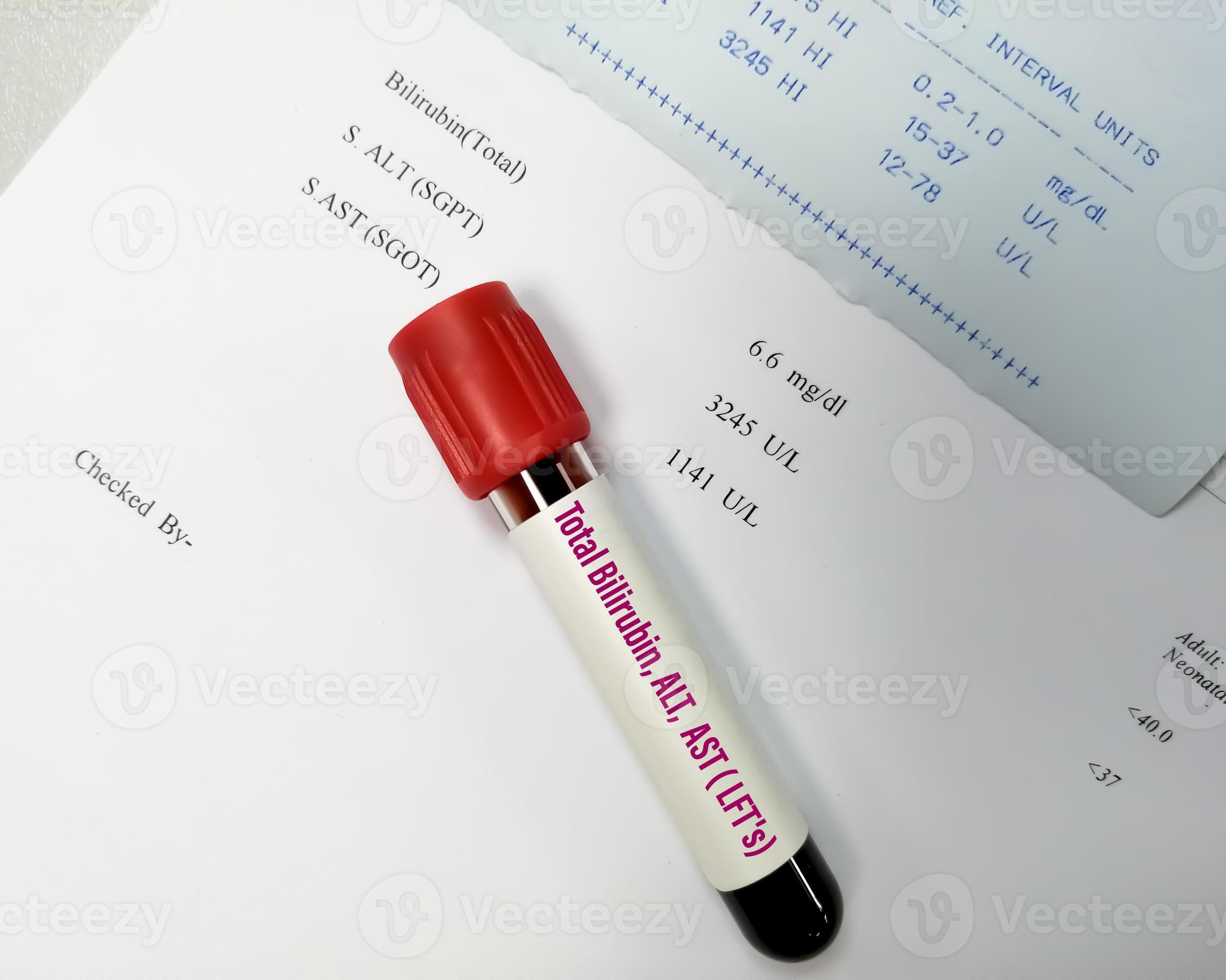 Blood sample for ALT, AST and Total Bilirubin test with abnormal report
