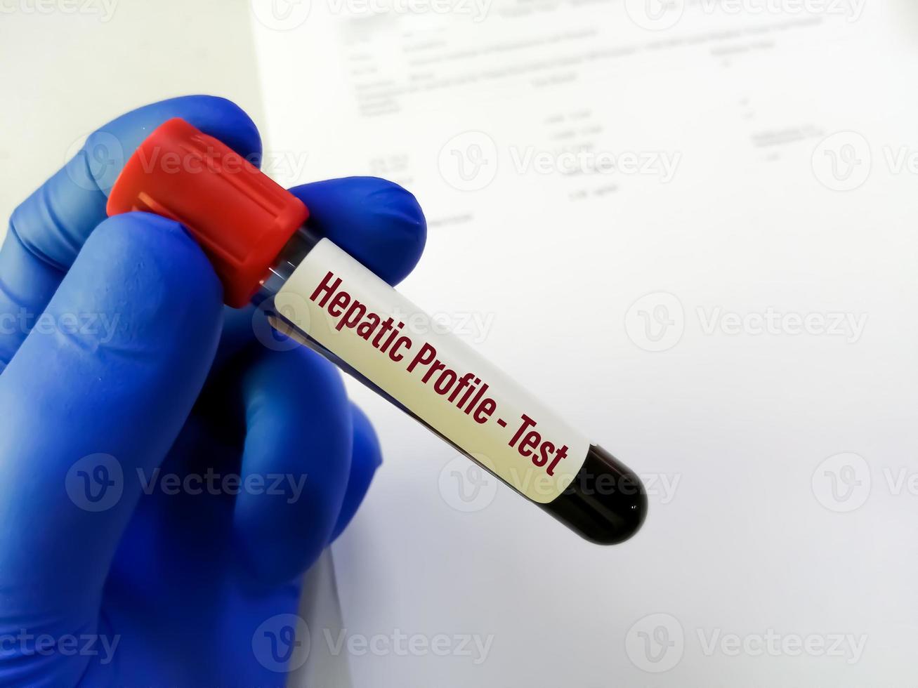 prueba de tubo de sangre para prueba de perfil hepático para diagnosticar enfermedad hepática. pruebas de función hepática. foto