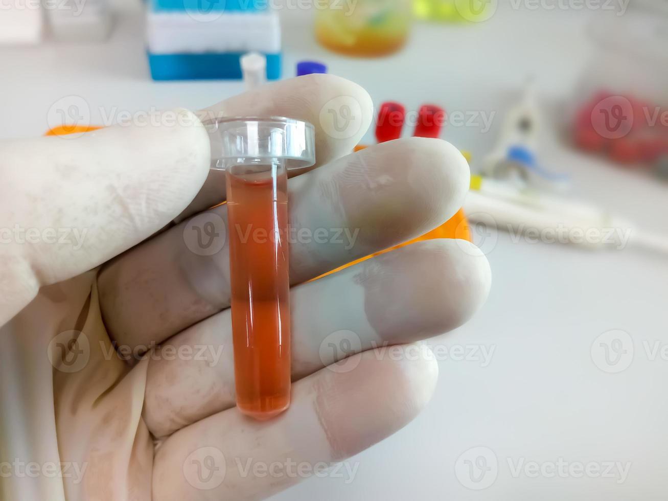 Biochemist hold Pleural fluid sample with laboratory background, which is ready for biochemical test including Glucose, Protein, ADA. Pleural effusion photo
