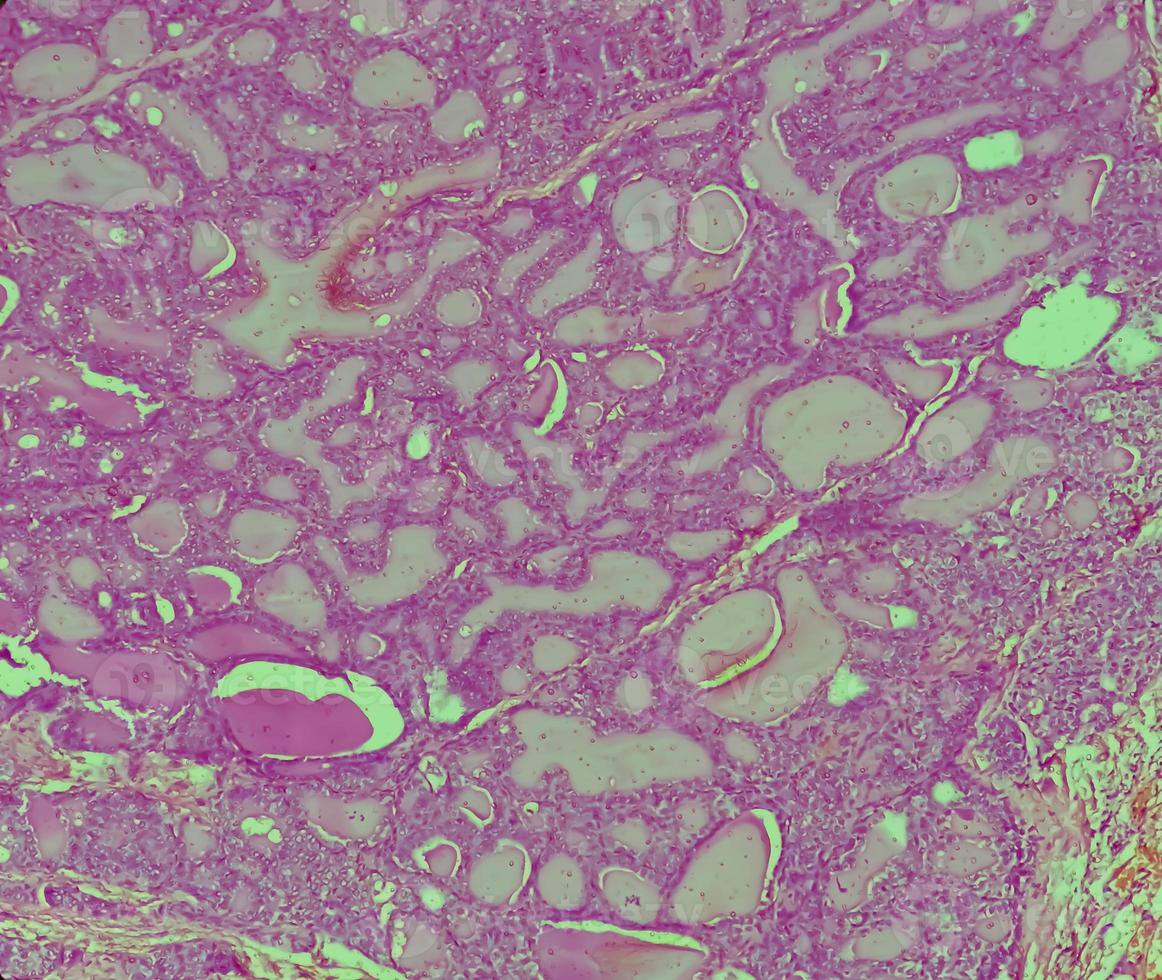 Thyroid cancer, Microscopic image of Metastatic papillary carcinoma of thyroid, central lymph node. photo