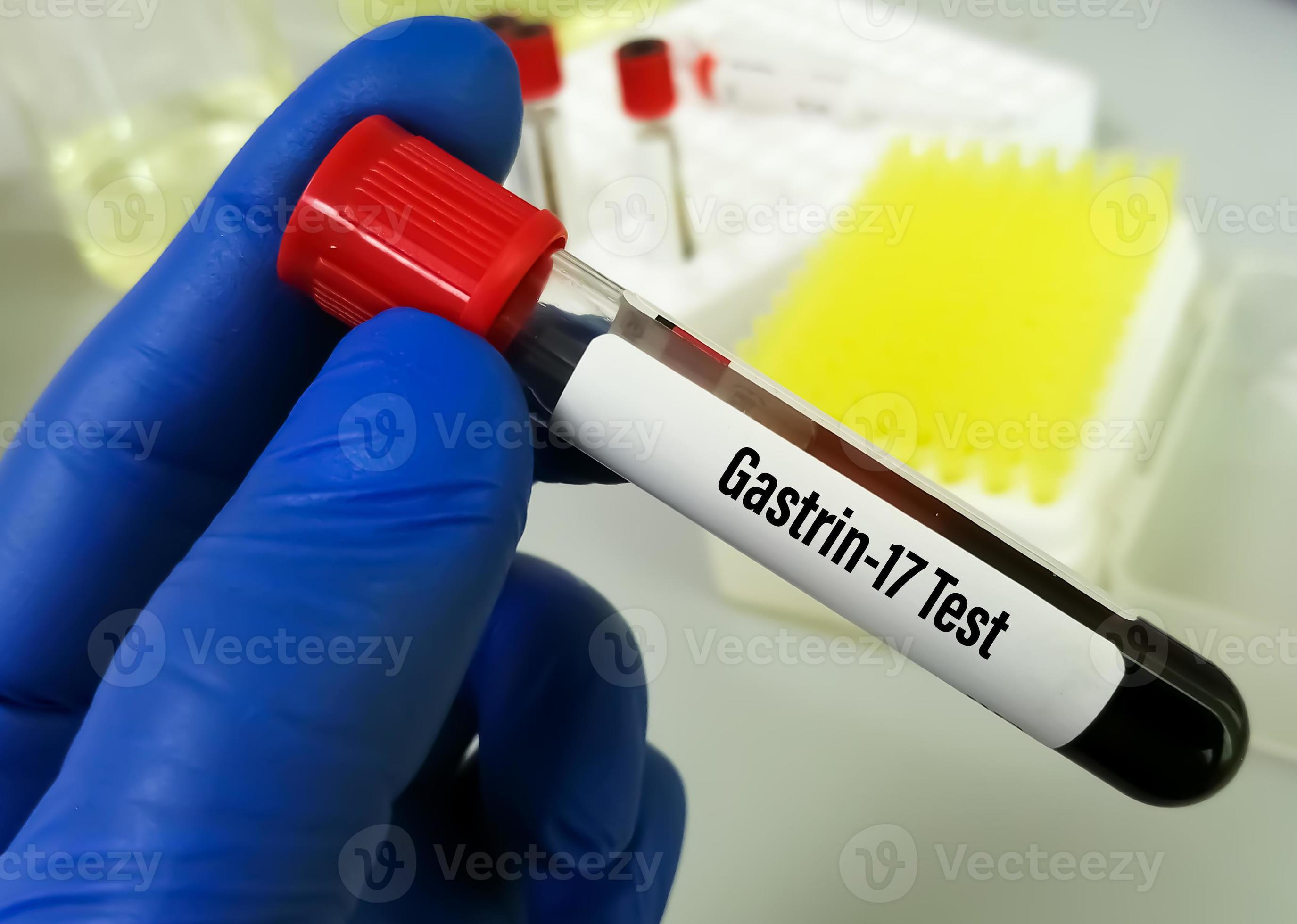 Blood sample for Gastrin 17 test to detect excess production of gastrin