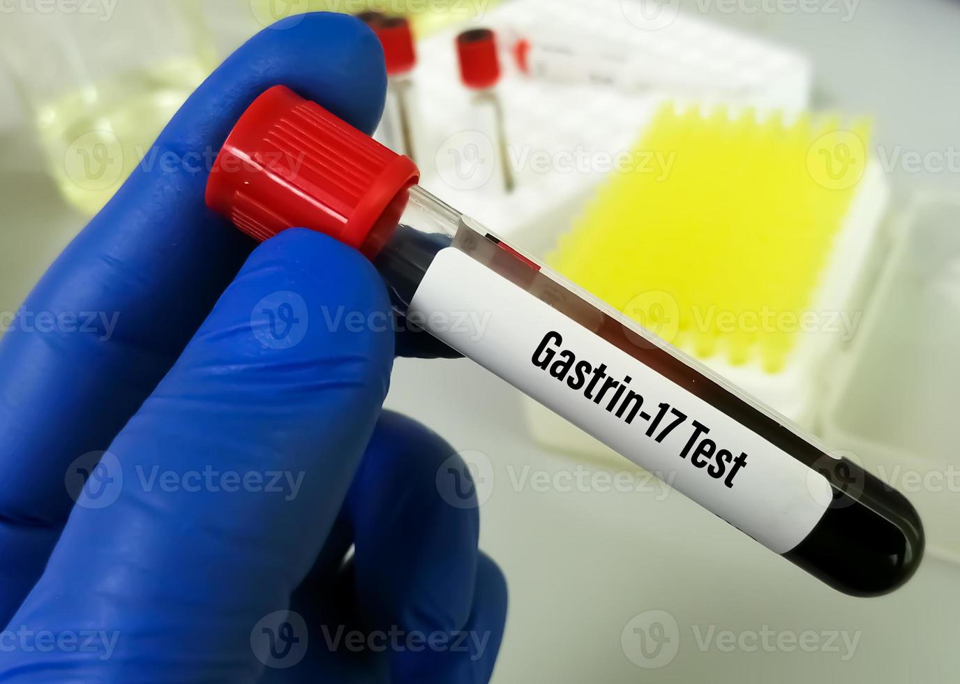 Blood sample for Gastrin 17 test  to detect excess production of gastrin and gastric acid. It is used to help diagnose gastrinoma, Zollinger-Ellison syndrome and hyperplasia of G cells. photo