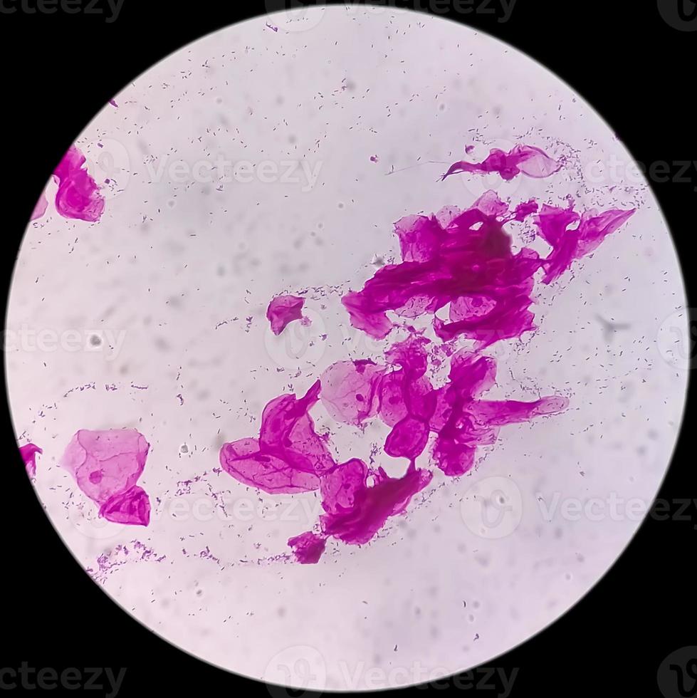 Gram staining, also known as Gram's method, is a method of differentiating bacterial species into two large groups called Gram positive and Gram negative photo