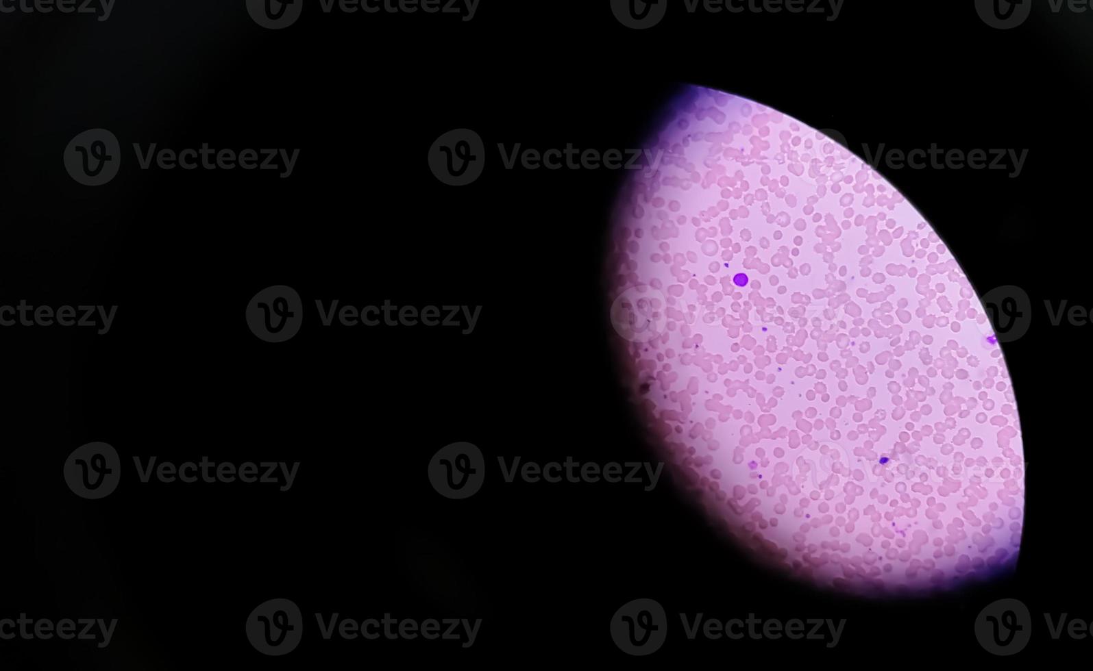 Photomicrograph or microscopic image showing Hemoglobin D trait with iron deficiency anemia. photo