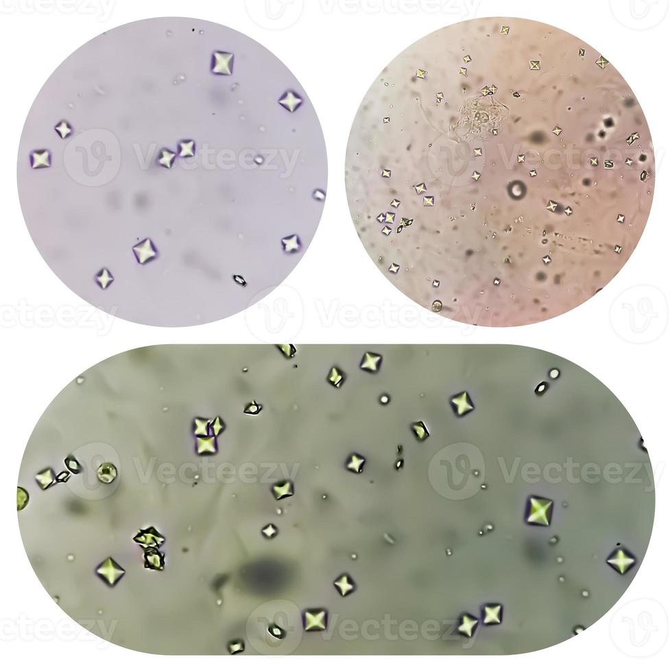 Calcium oxalate crystal from urine sediment. 8931022 Stock Photo at