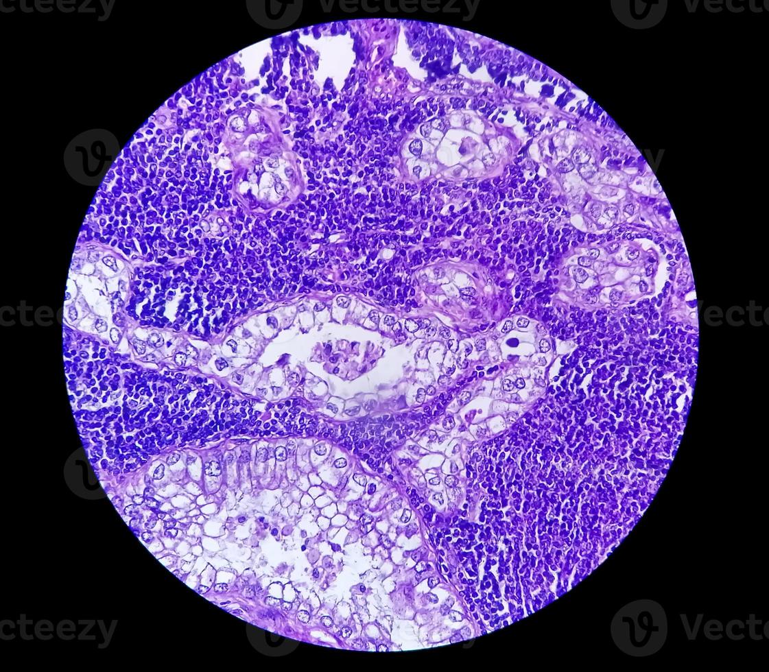 Photomicrograph or microscopic image of Stomach cancer. Adenocarcinoma of stomach photo