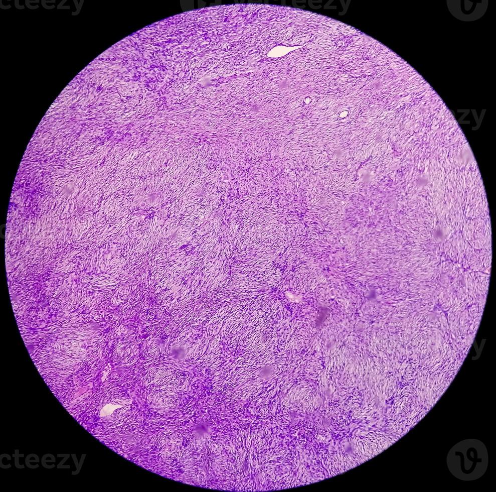 Photomicrograph of a schwannoma, a benign soft tissue tumor of peripheral nerve sheath. photo