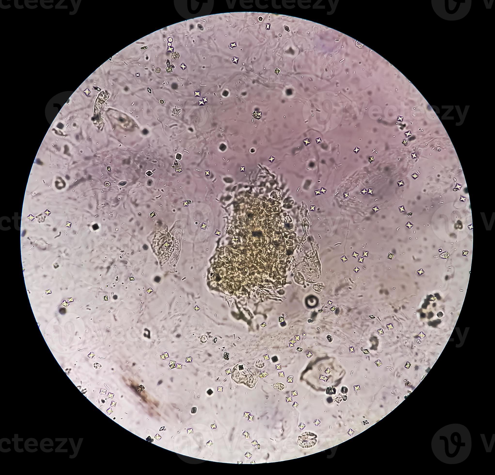 Microscopic image showing Calcium oxalate crystal and others urinary