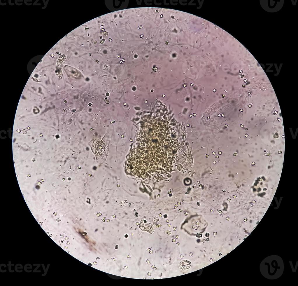 Microscopic image showing Calcium oxalate crystal and others urinary crystals from urine sediment. photo