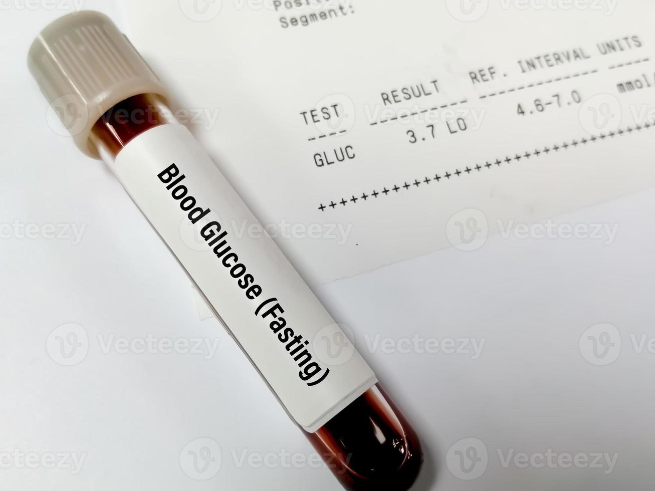 Sample tube of Plasma glucose Fasting test with abnormal report called