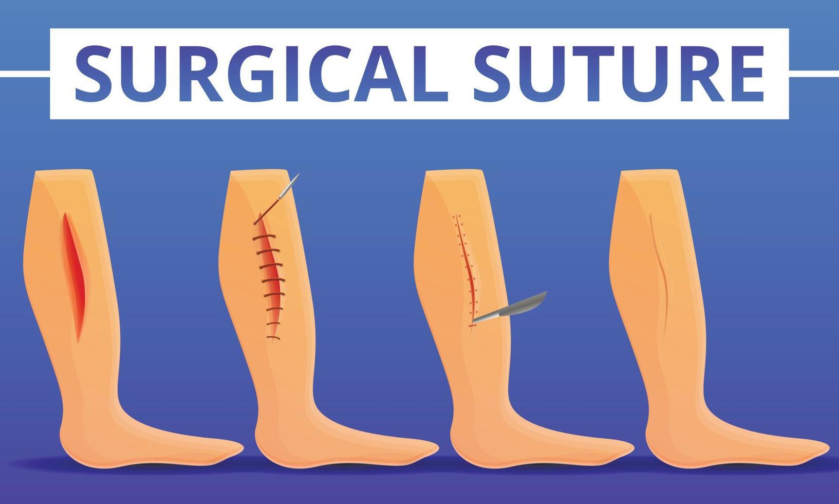 Fondo de concepto de sutura médica, estilo de dibujos animados vector