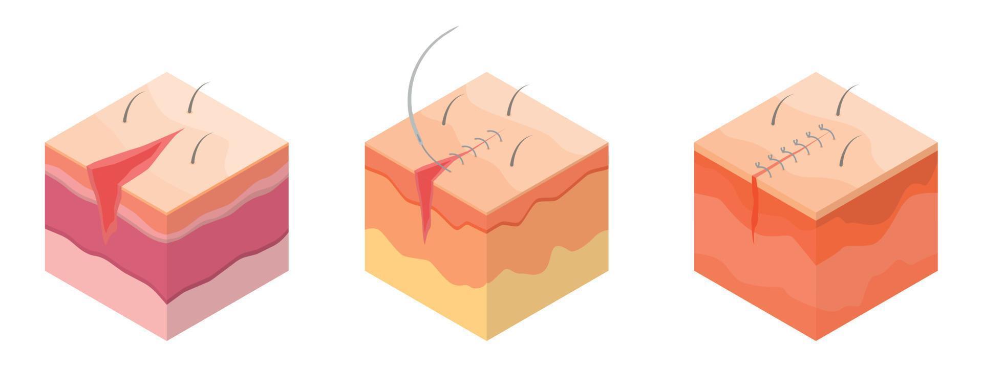 Surgical suture icons set, isometric style vector