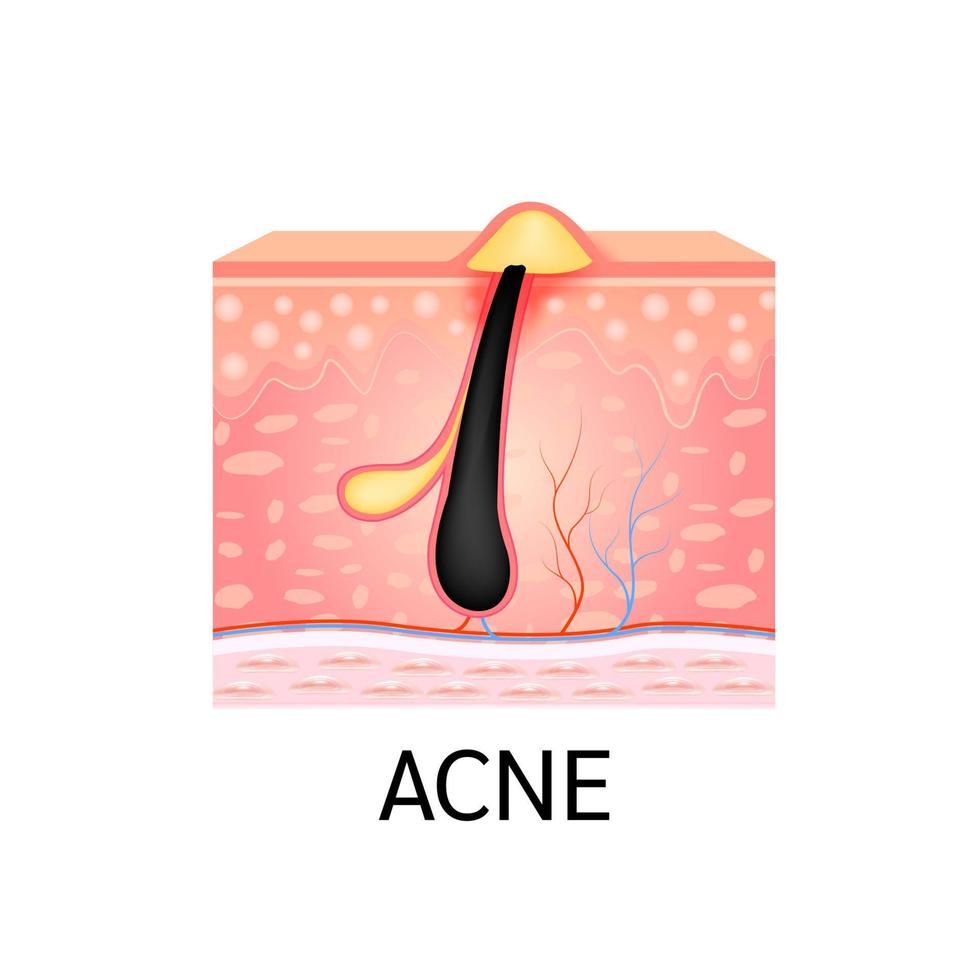 Ingrown hair. Hair has grown back into the skin surface after shaving. Formation of skin acne or pimple. Anatomy of hair and skin. Medical beauty skin care concept. On a white background. 3D vector. vector