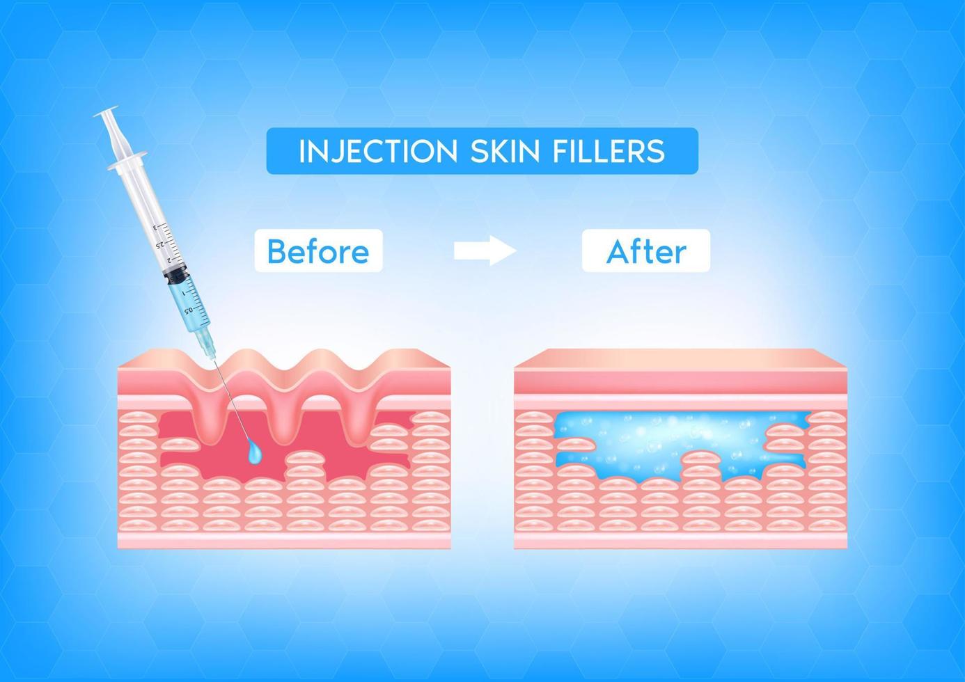 Injection filler injection under the skin on face with wrinkle dermal layer before and after. Facial hyaluronic acid HA-Filler. Medical and beauty concept. Vector EPS10 illustration.