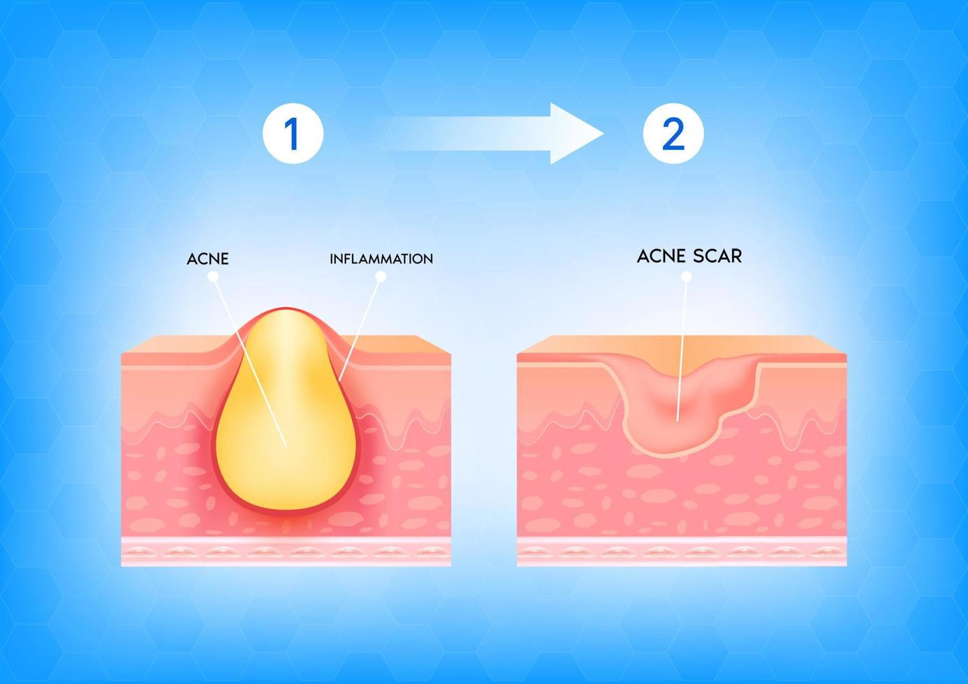 Inflamed acne on the skin. Inflammation associated with pimples. The structure of the skin acne scar. Medical beauty skin care concept. 3D vector illustration.