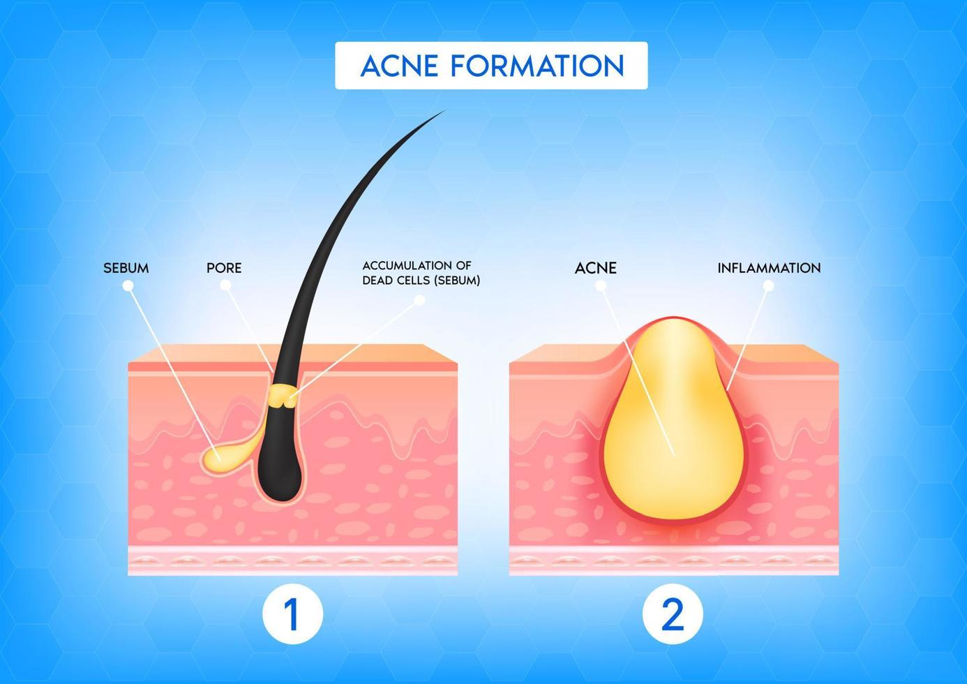 Formation of skin acne or pimple. Accumulation of dead cells and inflammation associated with pimples.The sebum in the clogged pore promotes the growth of a certain bacteria. 3D vector illustration.