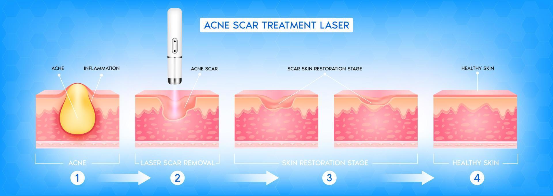 Acne scar vascular laser treatment. Inflammation associated with pimples. The structure of the skin acne scar. Medical beauty skin care concept. 3D vector illustration.