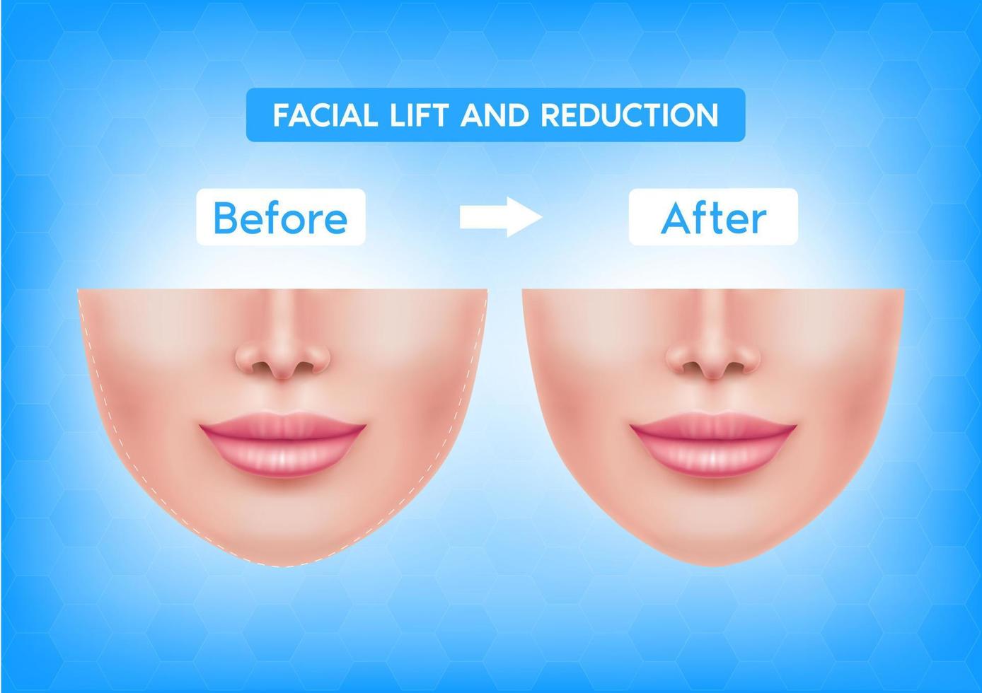 White female face before after plastic surgery jaw reduction and botox injections facial lift and reduction. For advertising of plastic surgery. Medical and beauty concept. Vector EPS10 illustration.