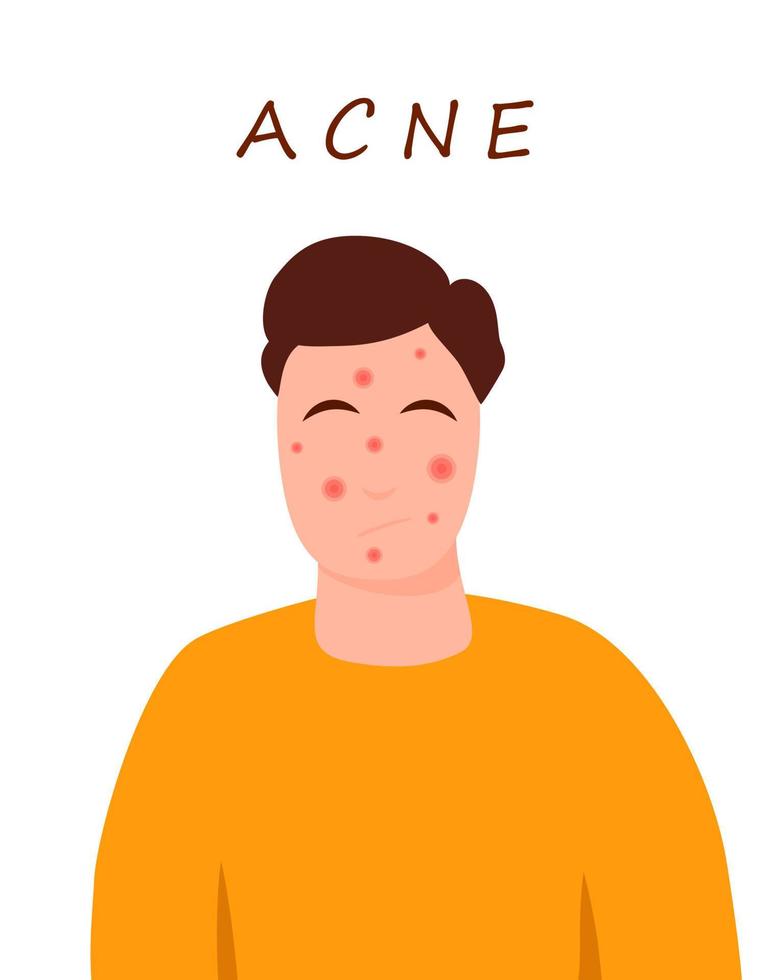 Cartoon teenage character with acne skin. Skin problems concept. Colorful vector illustration isolated on white background. Medicine and health care.