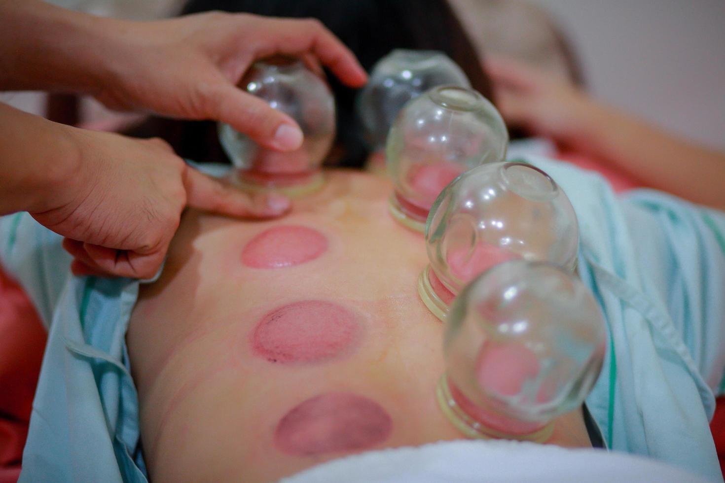 La ciencia de la medicina china es un método de tratamiento que utiliza la terapia de ventosas para calentar el aire en el aire y luego cerrar el flujo de la piel. estimula el sistema nervioso. foto