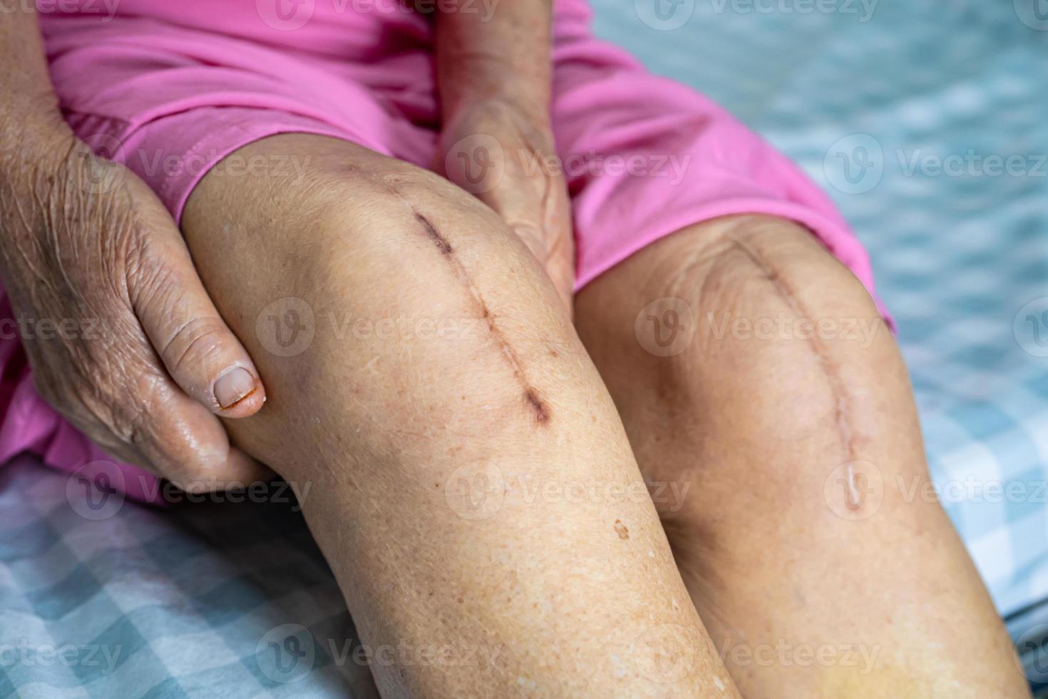 Asian senior or elderly old lady woman patient show her scars surgical total knee joint replacement Suture wound surgery arthroplasty on bed in nursing hospital ward, healthy strong medical concept. photo