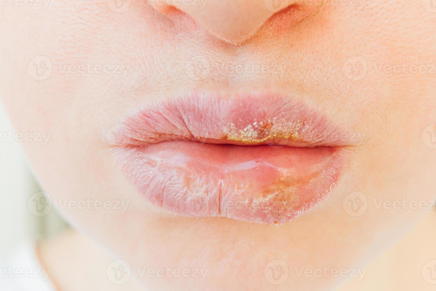 Close up of girl lips affected by herpes. Treatment of herpes infection and virus. Part of young woman face, lips with herpes affected. Beauty dermatology concept. photo