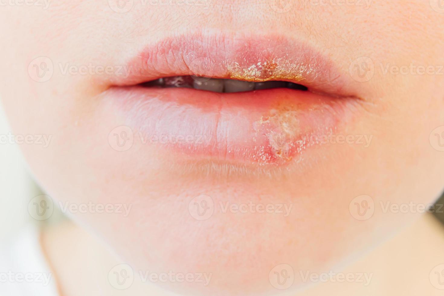 Close up of girl lips affected by herpes. Treatment of herpes infection and virus. Part of young woman face, lips with herpes affected. Beauty dermatology concept. photo