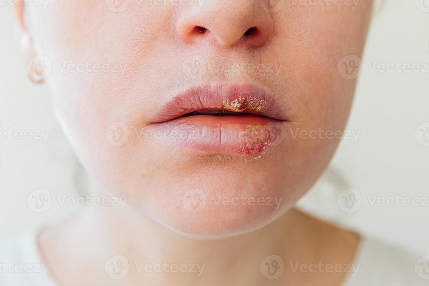 Close up of girl lips affected by herpes. Treatment of herpes infection and virus. Part of young woman face, lips with herpes affected. Beauty dermatology concept. photo