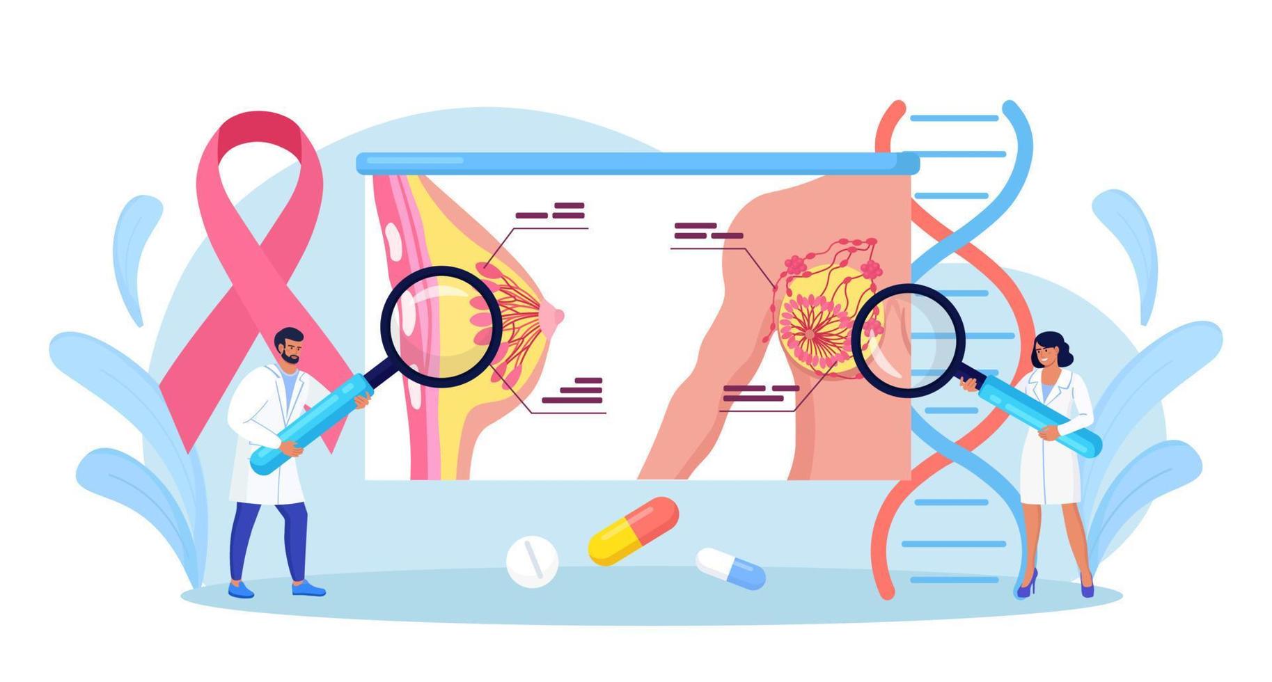 cáncer de mama. pequeños médicos mammólogos examinan a una paciente con lupa para tratar el cáncer. ultrasonido mamario y mamografía, diagnóstico de oncología. examen en la clínica, diagnóstico médico vector