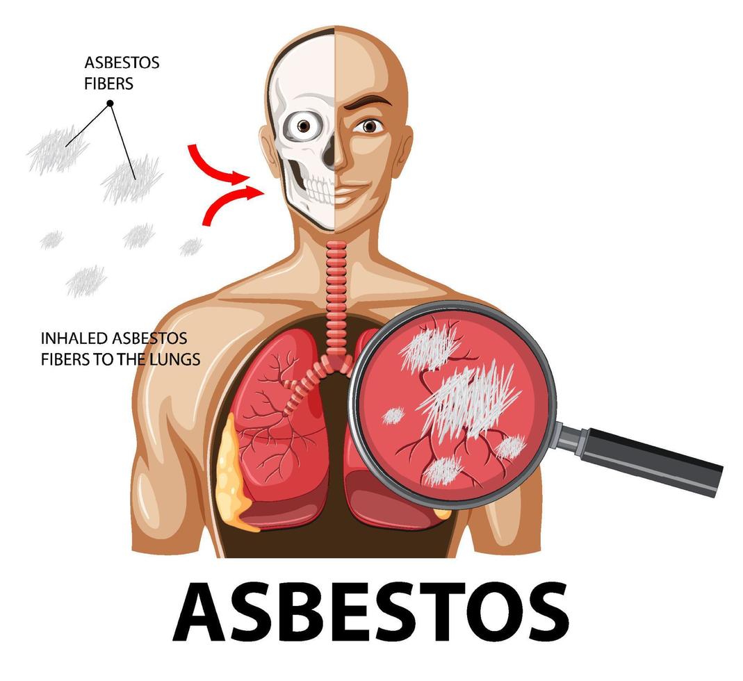 Diagram showing asbestosis in lungs vector