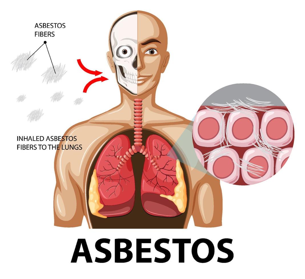 Diagram showing asbestosis in lungs vector