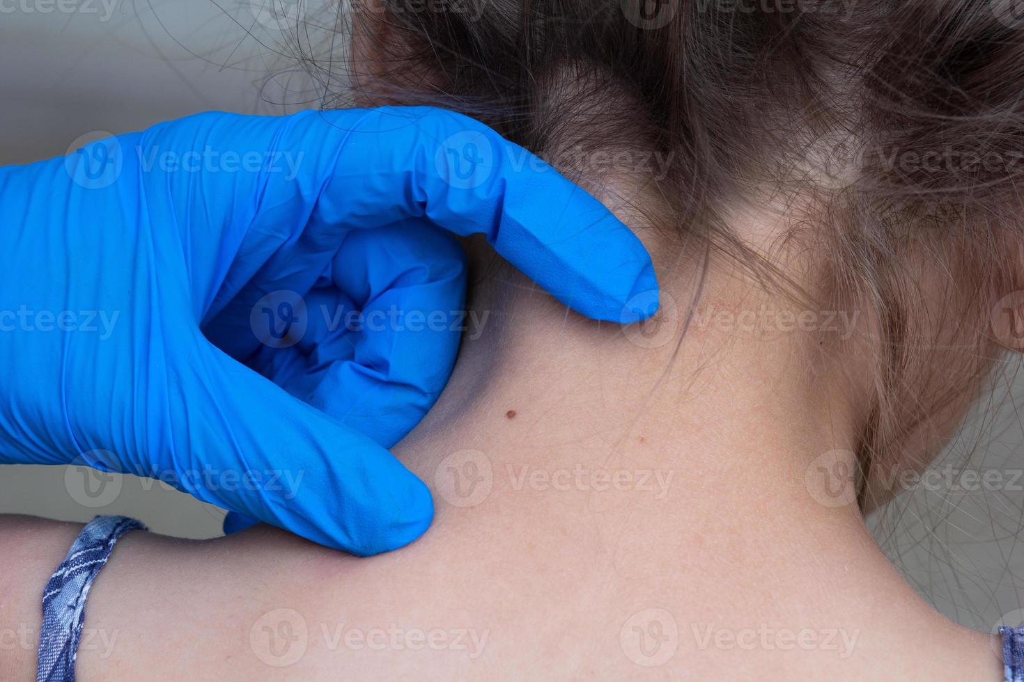 Birthmark on child neck photo