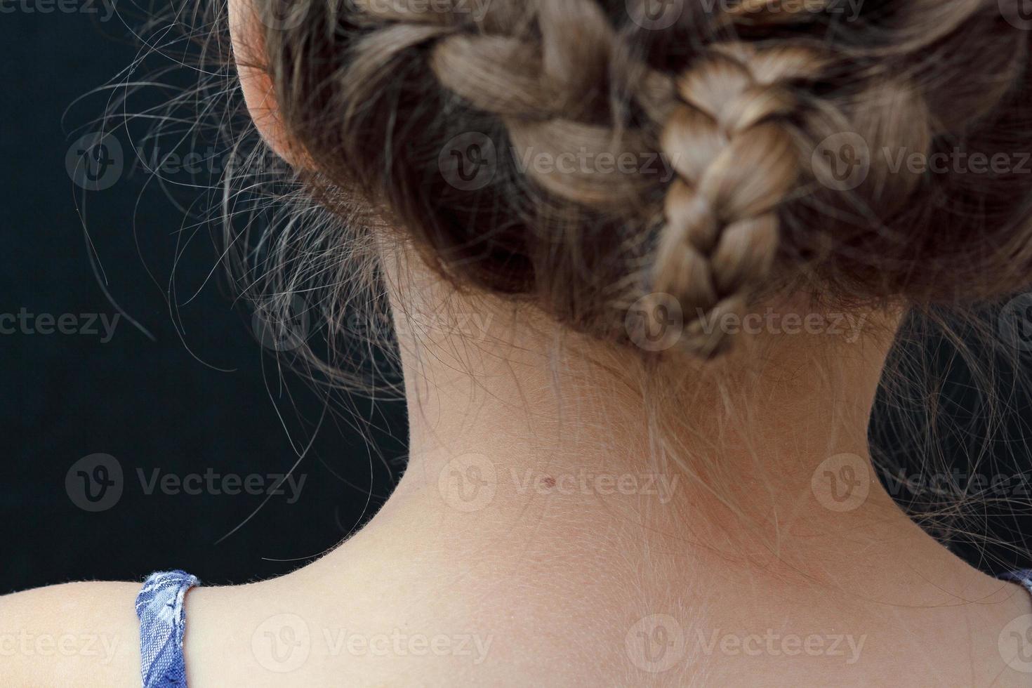 Birthmark on child neck photo