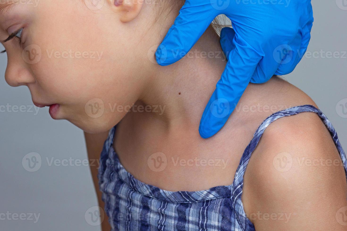 dedos adultos en el guante que muestran una marca de nacimiento en el cuello del niño foto