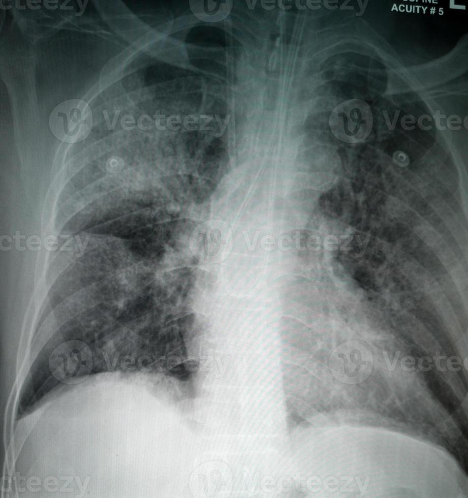 radiografía de tórax de un paciente con sospecha de virus corona imagen de alta calidad que muestra cambios en el pulmón debido al virus covid-19 con tubos torácicos foto