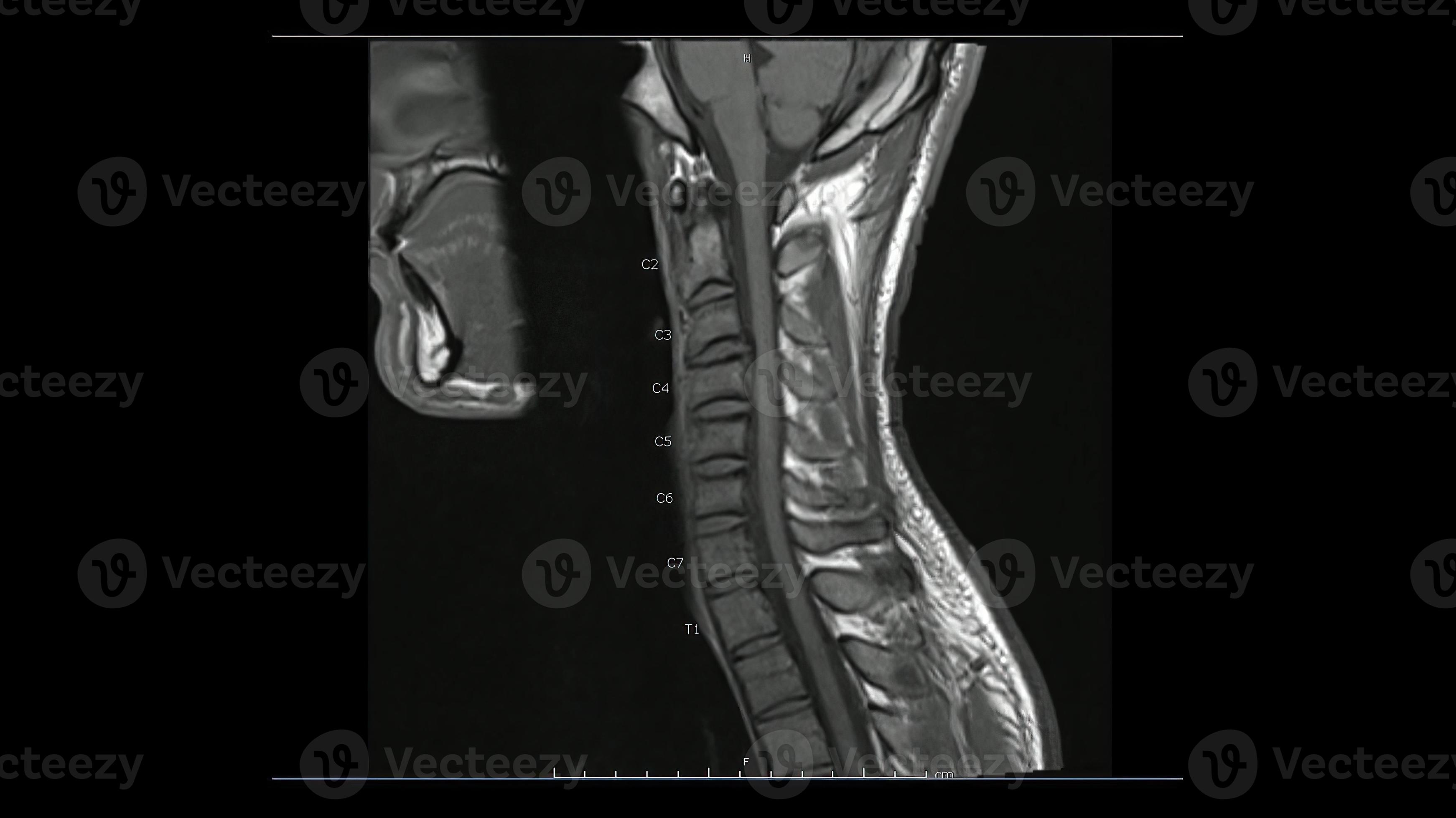 Magnetic Resonance Images Of Cervical Spine Sagittal T1 Weighted Images