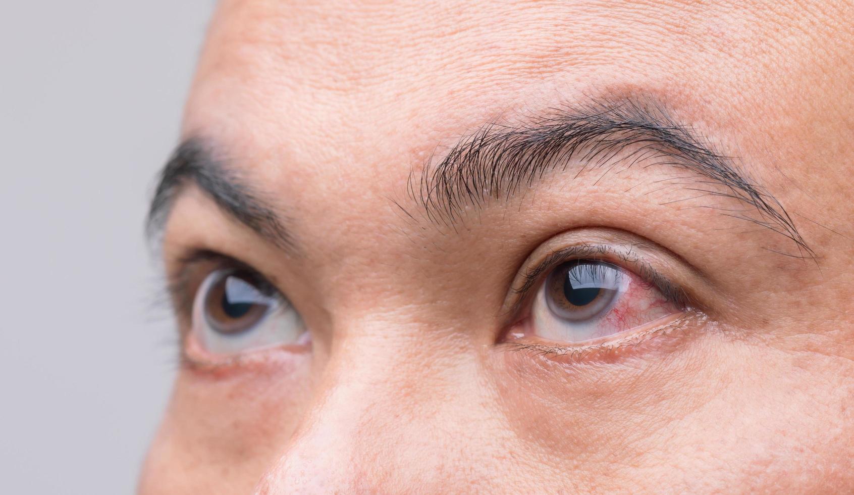 concepto de irritación ocular, ojo rojo del hombre, ojo de conjuntivitis o después de recibir polvo foto