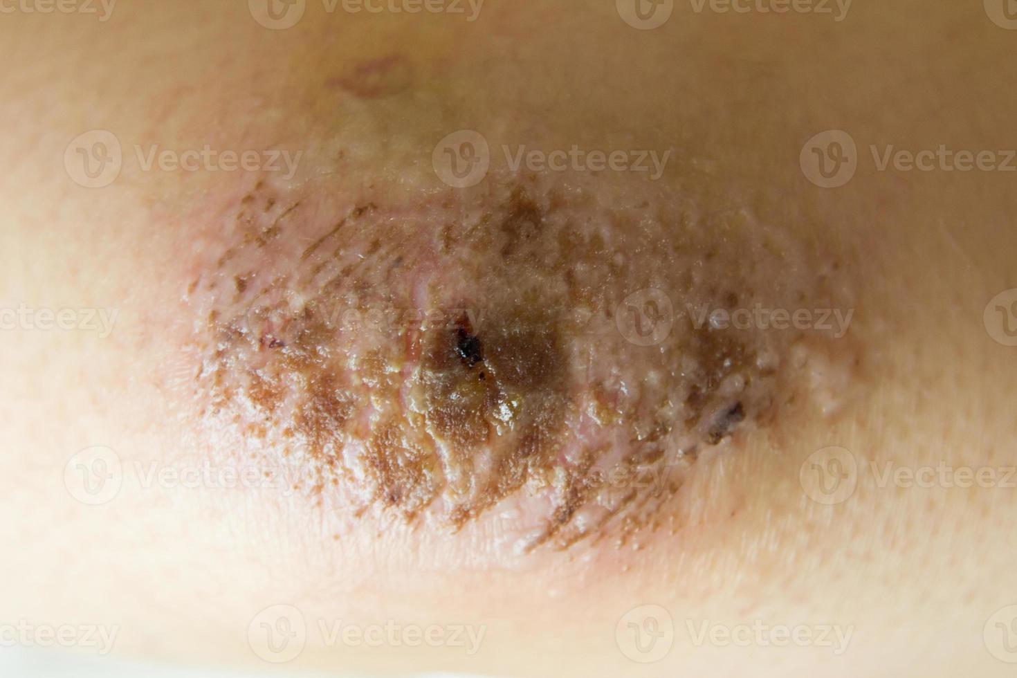 Closed up of red scab injury on woman knee background photo