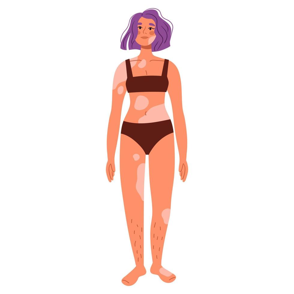 Women with vitiligo in swimsuit. Body-positive women. World vitiligo day. Skin disease Rare diseases. Flat vector illustrations