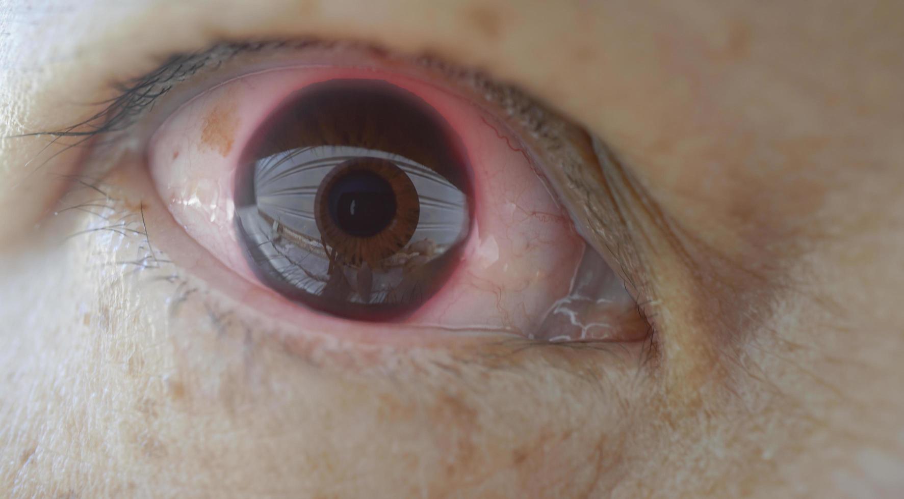 Close-up view of hemorrhage under the conjunctiva photo